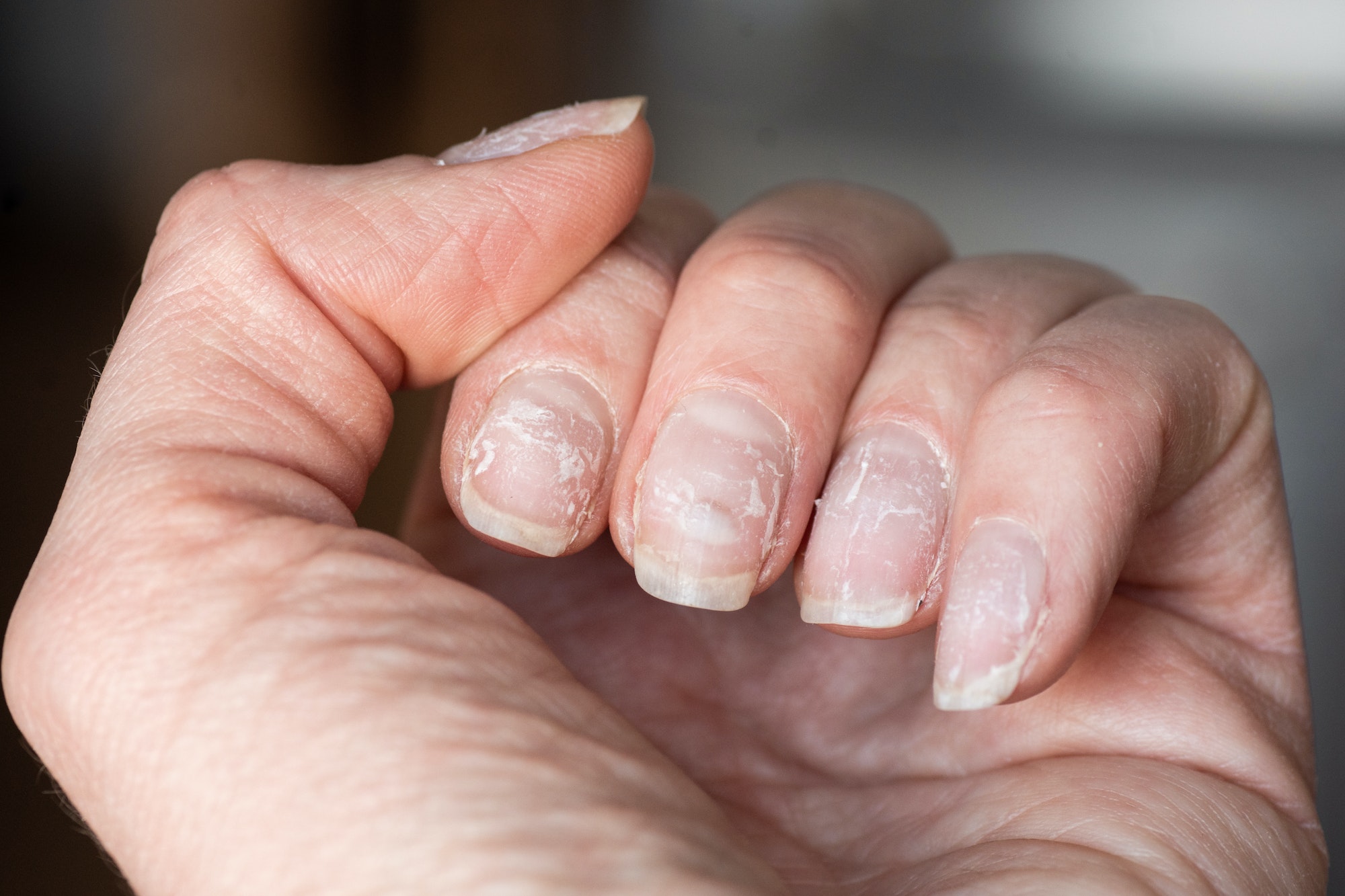 Comment arrêter de se ronger les ongles ?